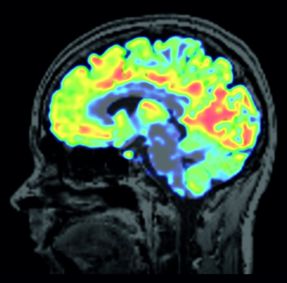 Kombinierte MR-PET-Aufnahme eines Gehirns